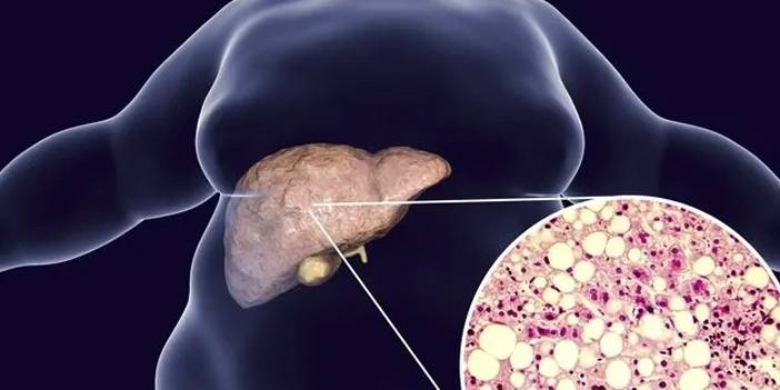 Türk doktor karaciğer yağlanması için onu önerdi: Sadece 2 bardağı ilaç gibi 4