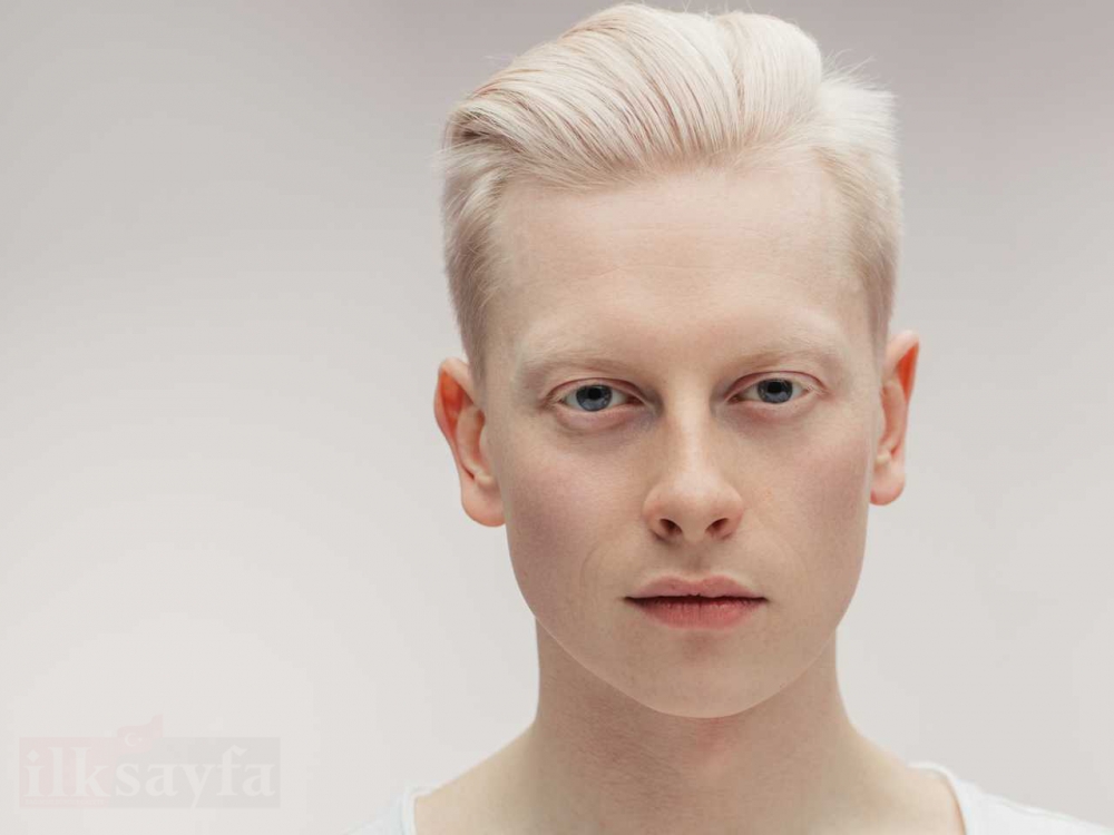 Dünya Albinizm Farkındalık Günü ve beyaz genli Albinolar 1
