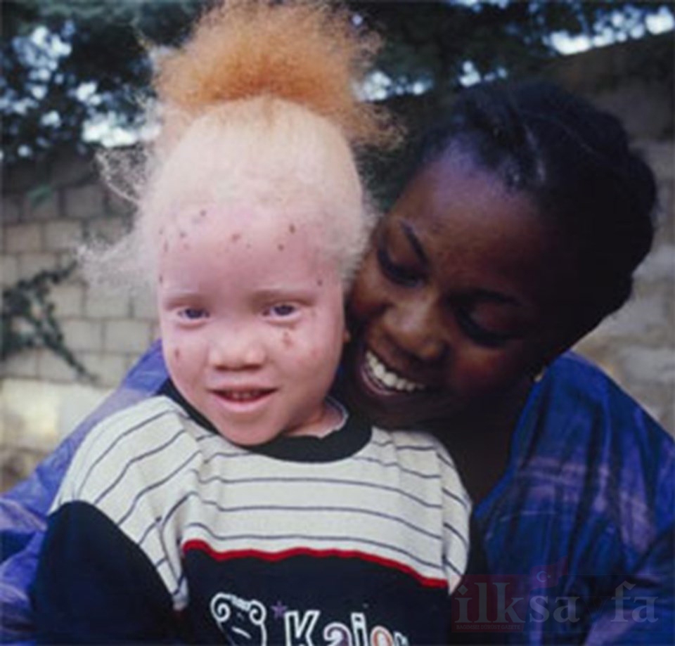 Dünya Albinizm Farkındalık Günü ve beyaz genli Albinolar 5