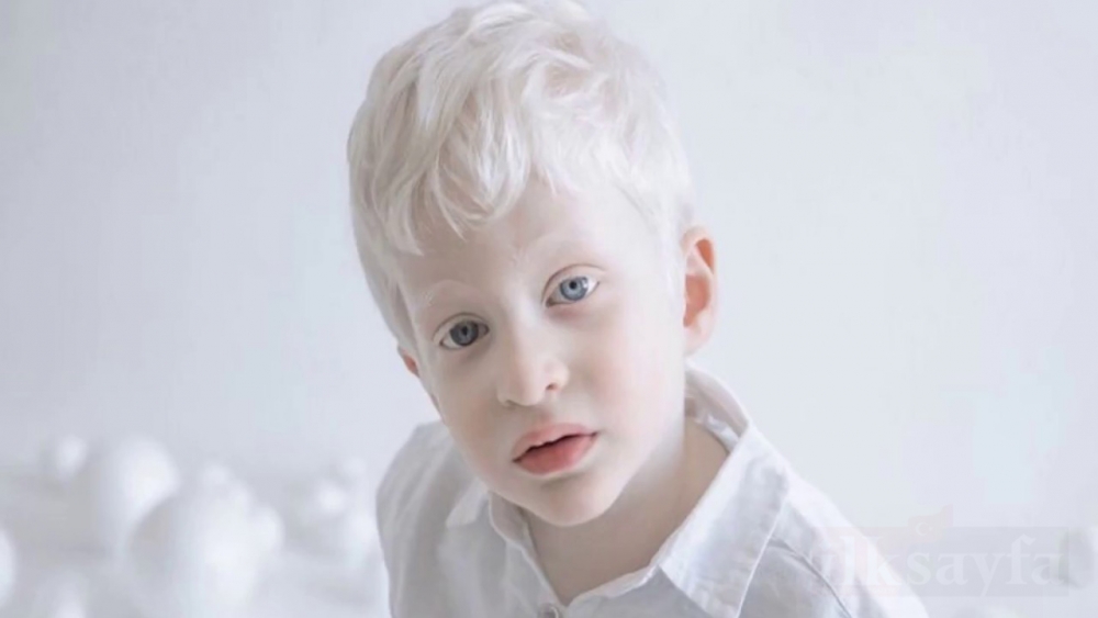 Dünya Albinizm Farkındalık Günü ve beyaz genli Albinolar 6
