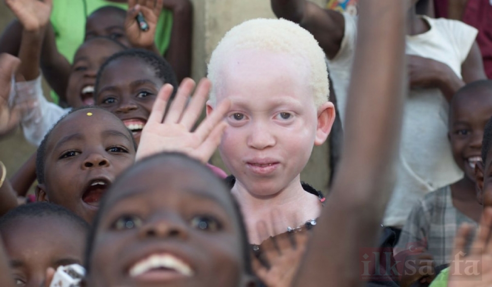 Dünya Albinizm Farkındalık Günü ve beyaz genli Albinolar 7