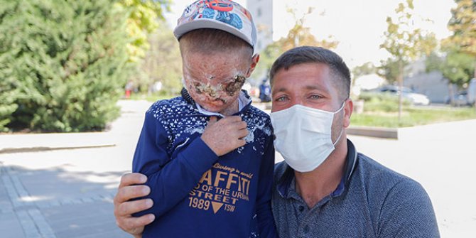 Cilt kanseri Salih'in tedavisi Ankara'da başladı