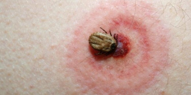 Lyme hastalığı tedavi sonrası sendroma dönüşebilir