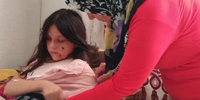 Samsun'da pitbull saldırısına uğrayan Tuğba'ya, 60 dikiş atıldı