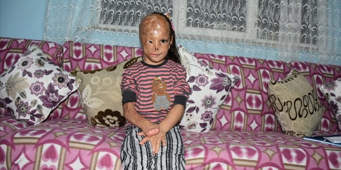 Bebekken yüzü yanan 5 yaşındaki Dilara ameliyat olmak için yardım bekliyor