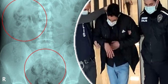 Otogarda rahatsızlanan İranlının midesinde 890 gram uyuşturucu çıktı