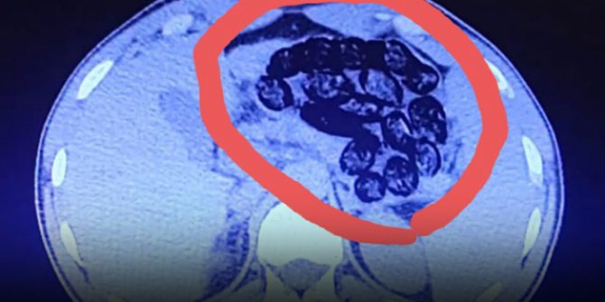 Van'da, 2 İran uyruklunun midesinden 103 kapsül metamfetamin çıktı
