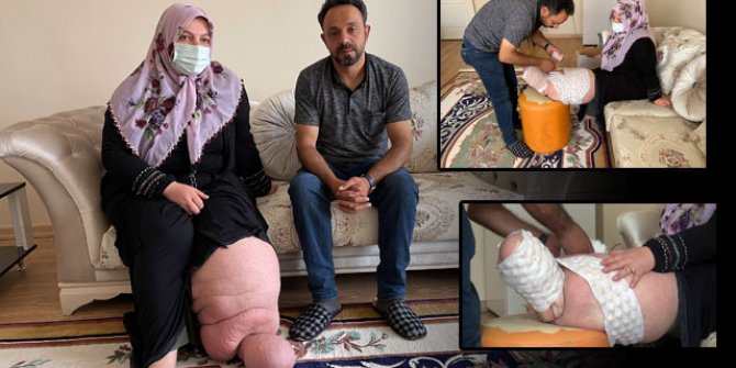 Fil hastası Ayşe'nin ayakkabı ve çorap giyme hayali