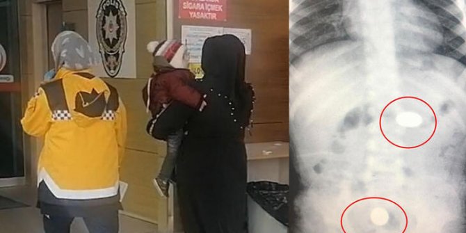 2 madeni para yutan Murat bebek, hastanelik oldu