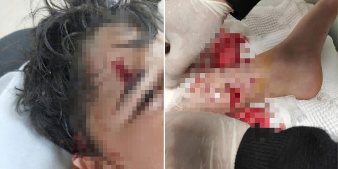 Okul yolunda 8 köpeğin saldırdığı çocuğun vücuduna 80 dikiş atıldı