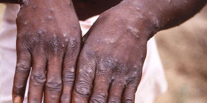 DSÖ: Dünya çapında doğrulanmış 80 maymun çiçeği vakası var