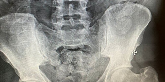 Hepsi midesindeydi: Tam 100 adet! Hastaneye götürülünce ortaya çıktı