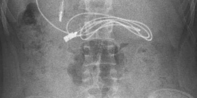 Diyarbakır’da çocuğun midesinden toka ve 1 metrelik kablo çıktı