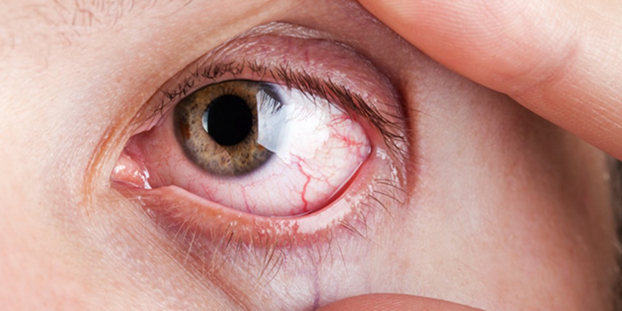 Glokom hastalığı körlük riski barındırıyor