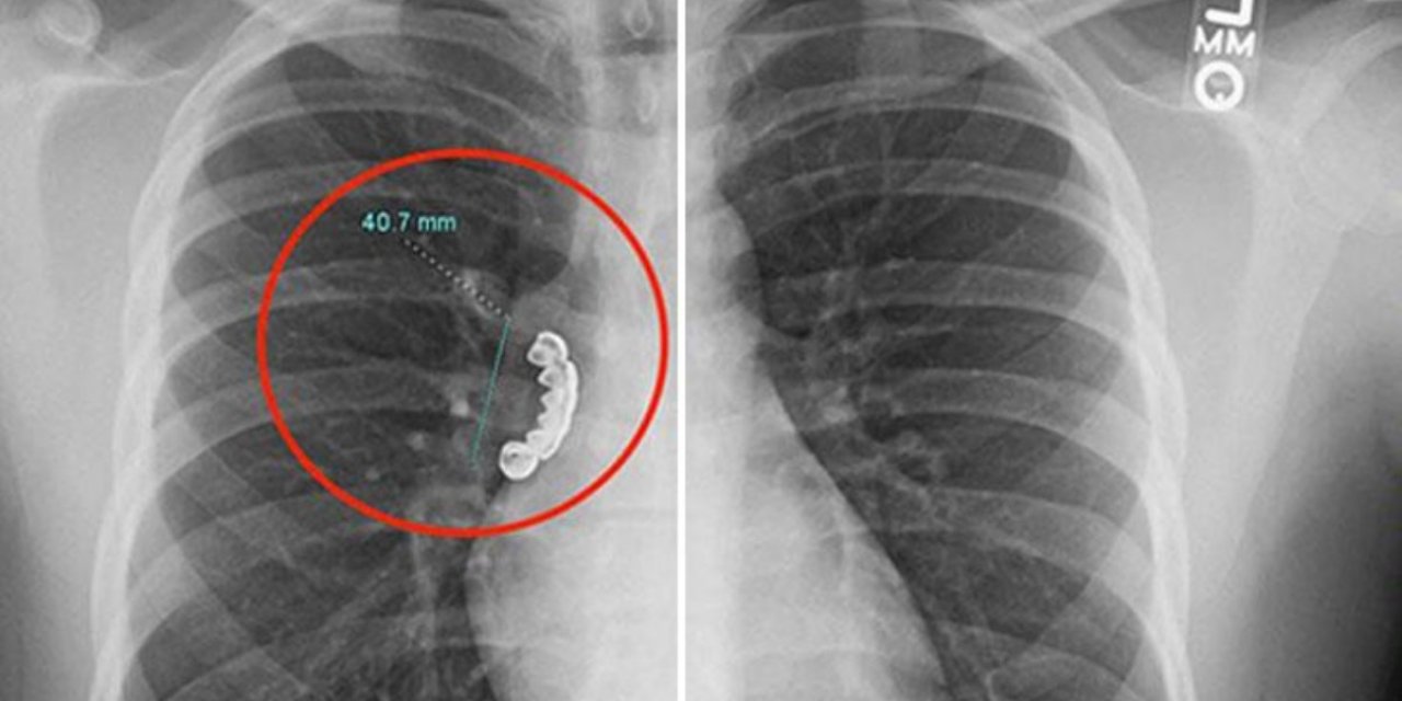 Epilepsi krizi geçiren gencin takma dişi ciğerine takılı kaldı