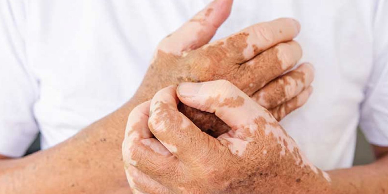 Vitiligo Nedir? Vitiligo nasıl ortaya çıkar?