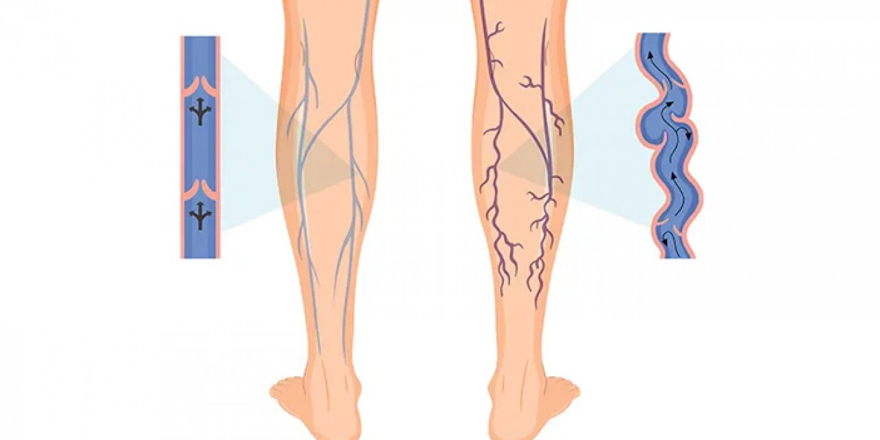 Uzun süreli oturmak  varisi tetikliyor