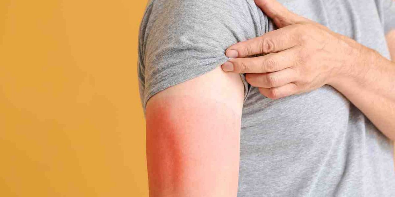 Yaz aylarının kabusu... Güneş yanığına iyi gelen o yöntem!