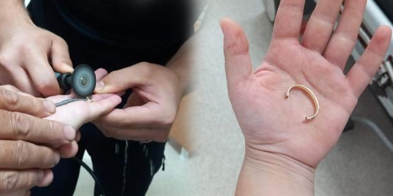 Yüzüğü parmağından çıkaramadı: Kesilerek çıkarıldı