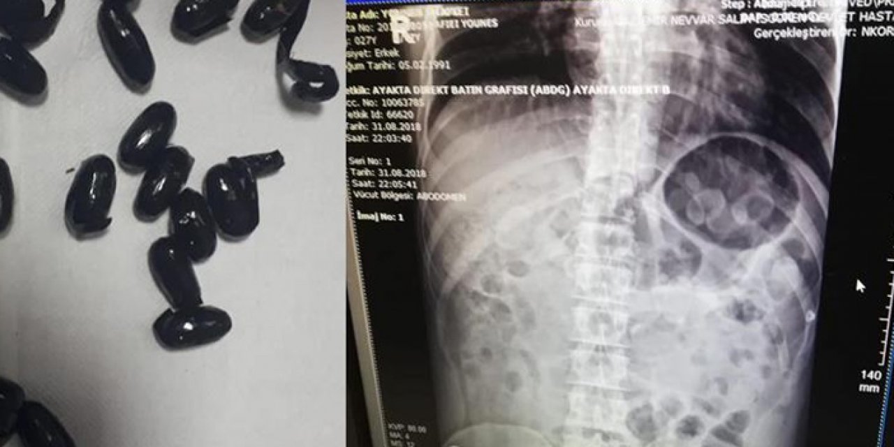 Midesinde uyuşturucuyla yakalanan şüpheli tutuklandı!