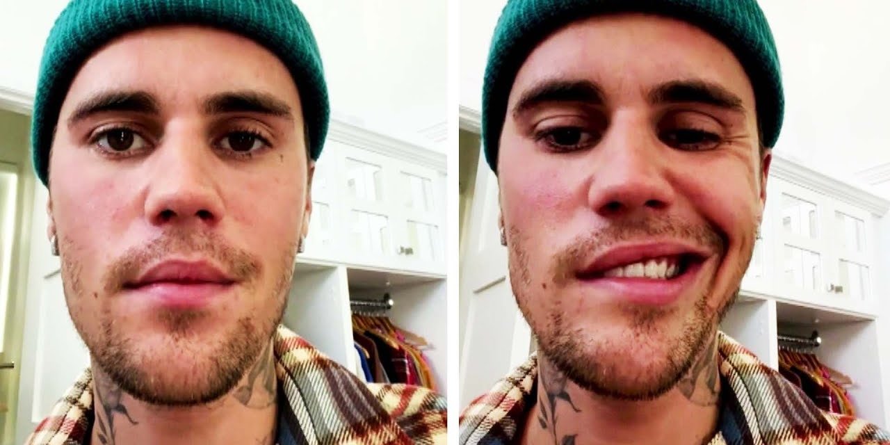 Ramsay Hunt Nedir? Ramsay Hunt Sendromu Nedir? Ramsay Hunt Belirtileri Nelerdir?