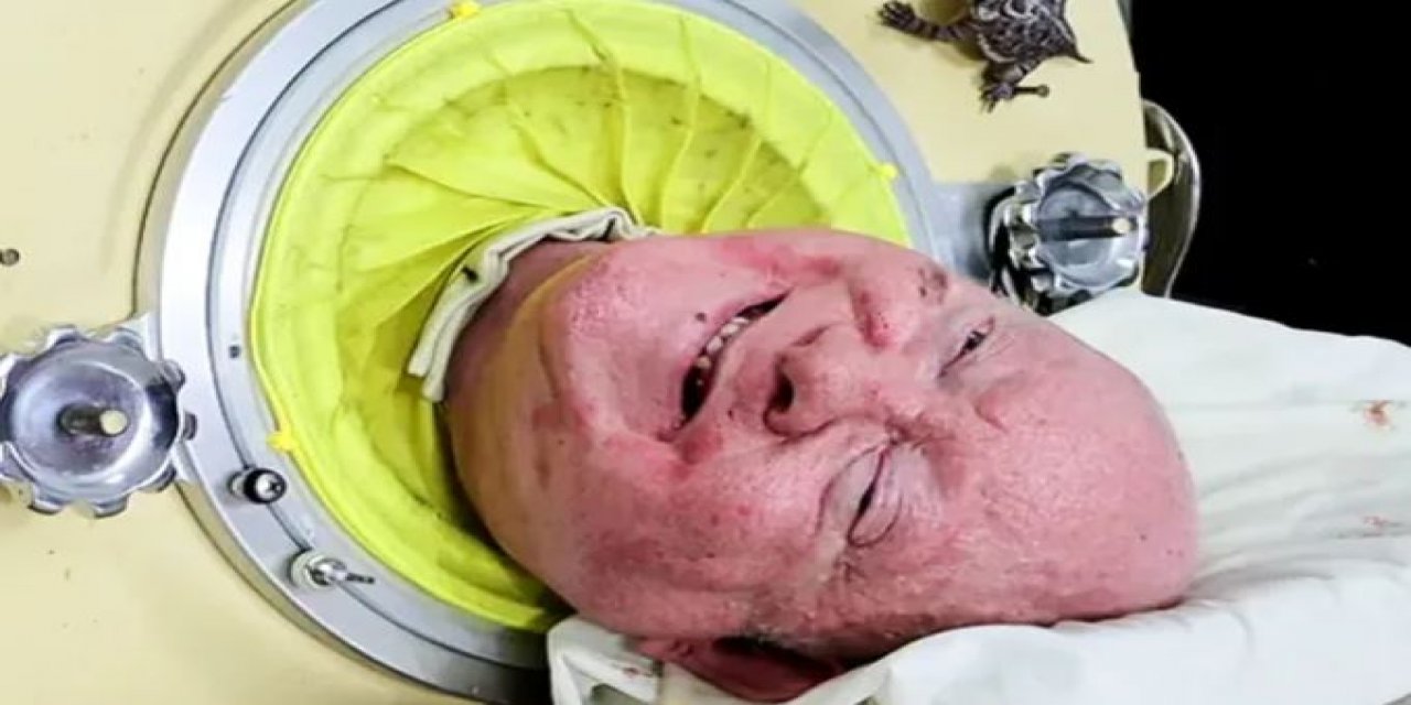 Paul Alexander Kimdir? Demir Akciğer Kimdir? Paul Alexander Hayatı?