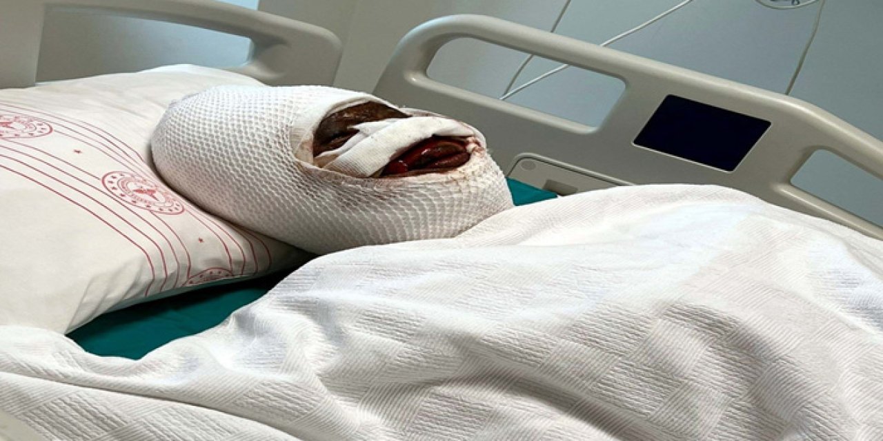 Koli Bandıyla Bağlayıp Kezzap Döktü: Genç Kadın Yoğun Bakımda