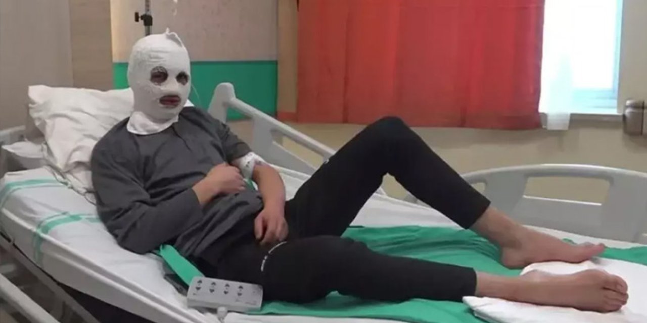 Çakmağı Doldururken Elinde Patladı! Yüzü ve Göğsü Yandı