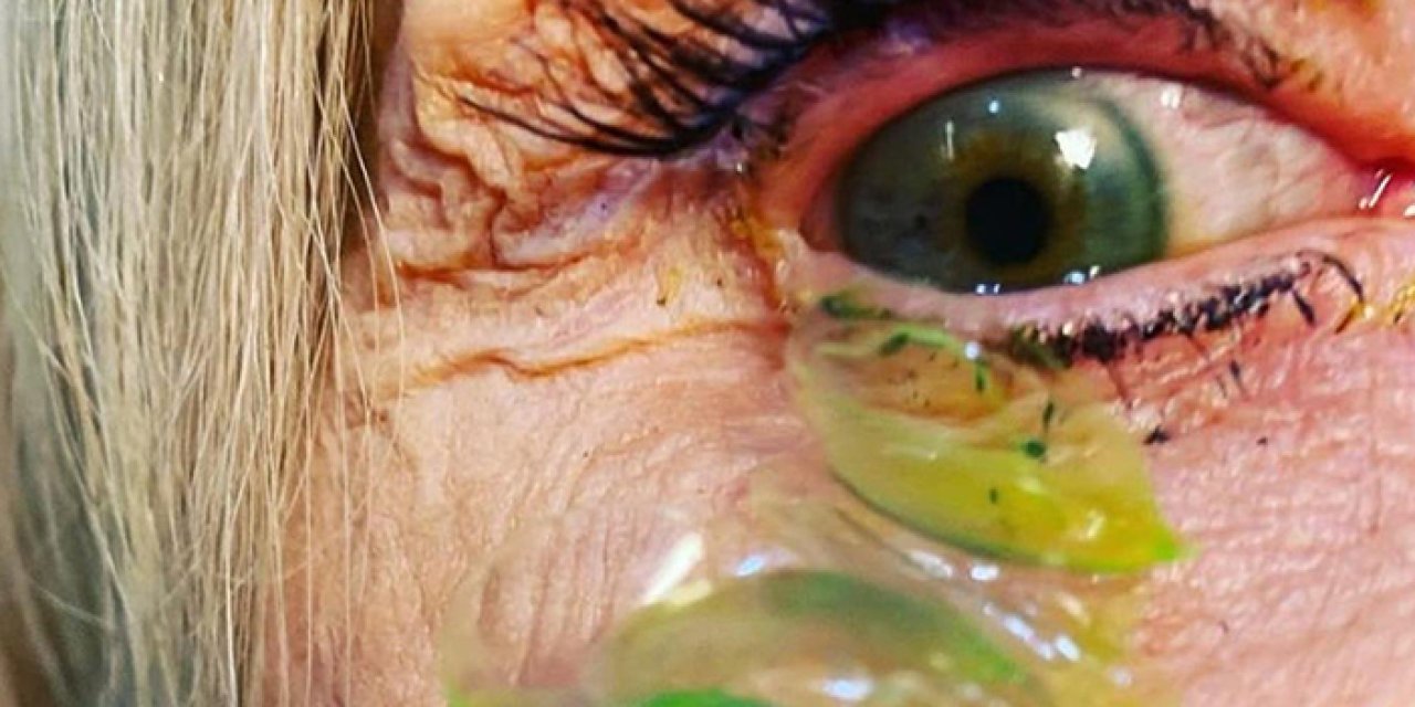 Reçetesiz lenslere dikkat: Görme kaybına yol açabilir