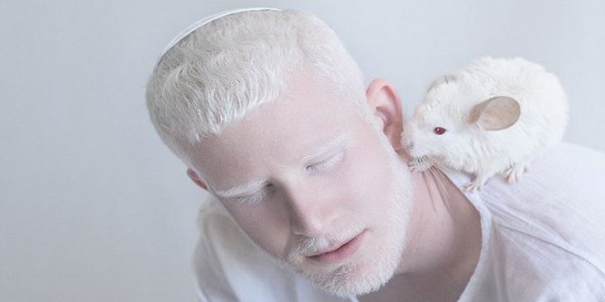 Albino hastalığı nedir? Tedavisi var mıdır?