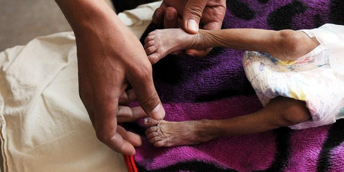 ICRC'nin Ortadoğu'daki sözcüsü Zevkari: Milyonlarca Yemenli aç uyuyor