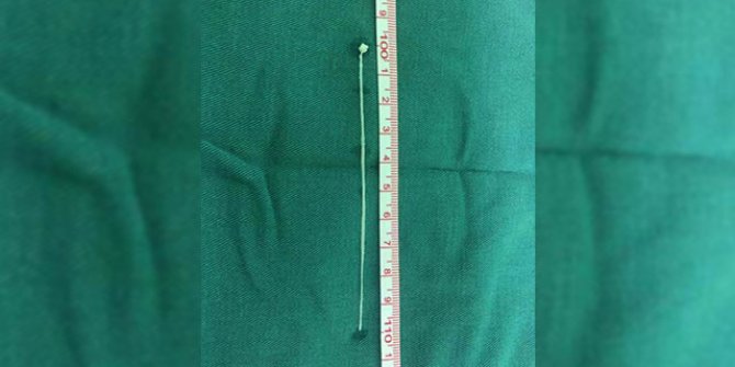 Beyninde kurtla 30 yıl yaşadı