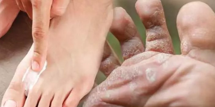 Ayak mantarı belirtileri nelerdir?