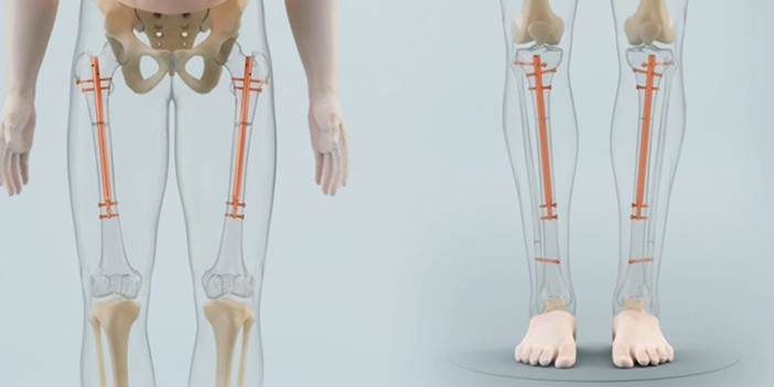 boy uzatma ameliyatı